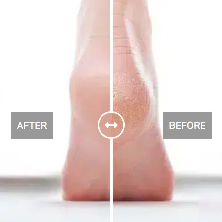 פילינג לכף הרגל - לפני / אחרי פילינג לכף הרגל - לפני / אחרי