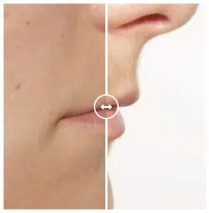 הסרת צל שפם בשפה העליונה הסרת צללית שפם בשפה העליונה